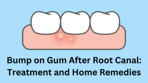 Bump on Gum After Root Canal Treatment and Home Remedies